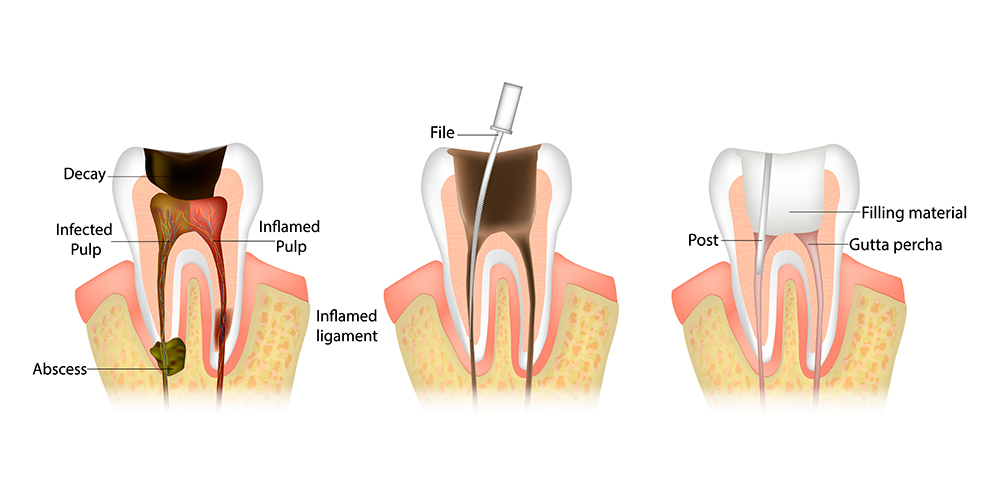 Endodontic root canal treatment process. Dentistry, dental restoration concept. Tooth decay caries disease development